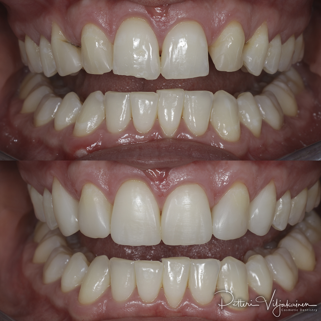 Invisalign oikomishoito. Tyytyväinen asiakas.