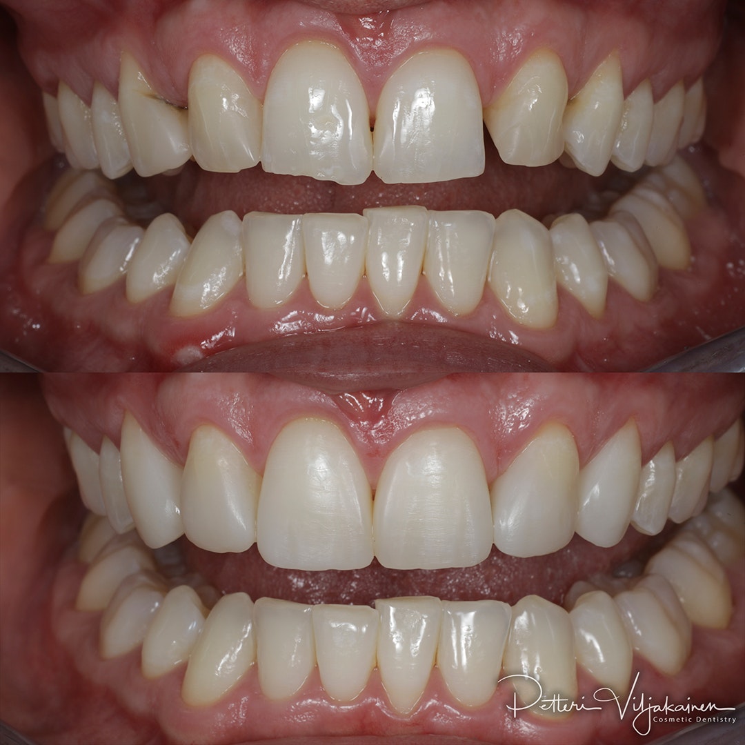 Invisalign oikomishoito. Tyytyväinen asiakas.