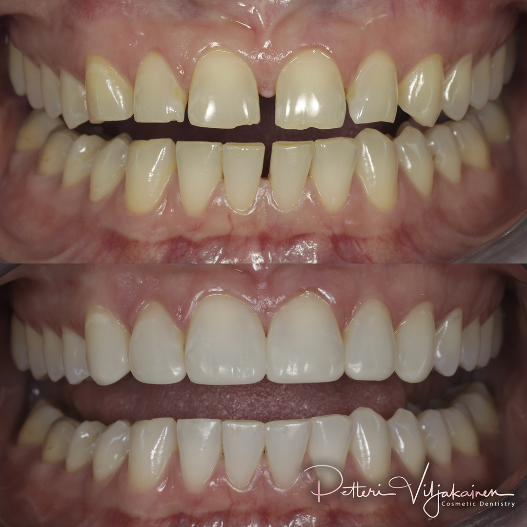 Invisalign oikomishoito ennen.