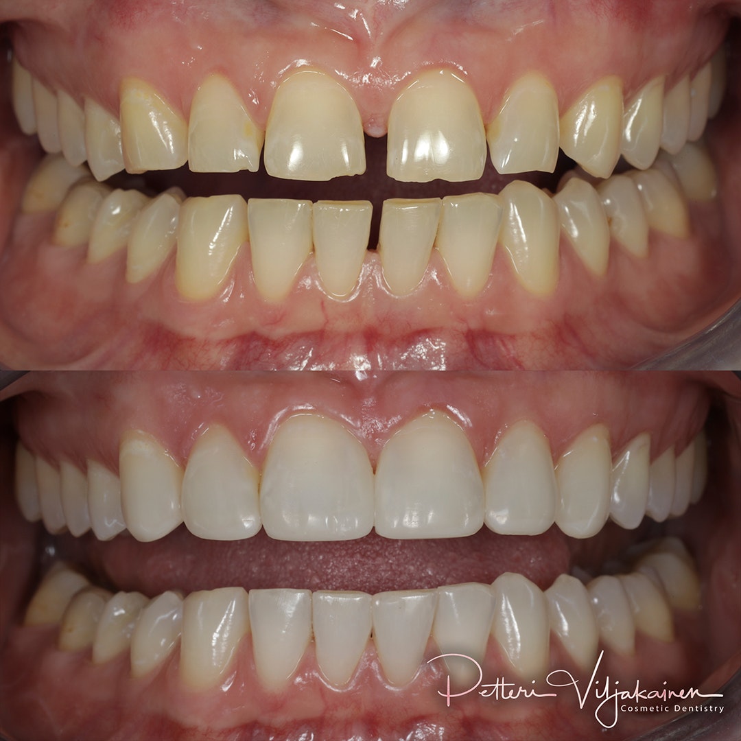 Invisalign oikomishoito ennen.