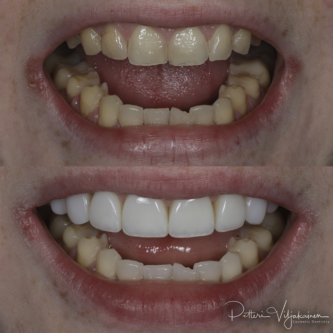 Invisalign oikomishoito ennen.