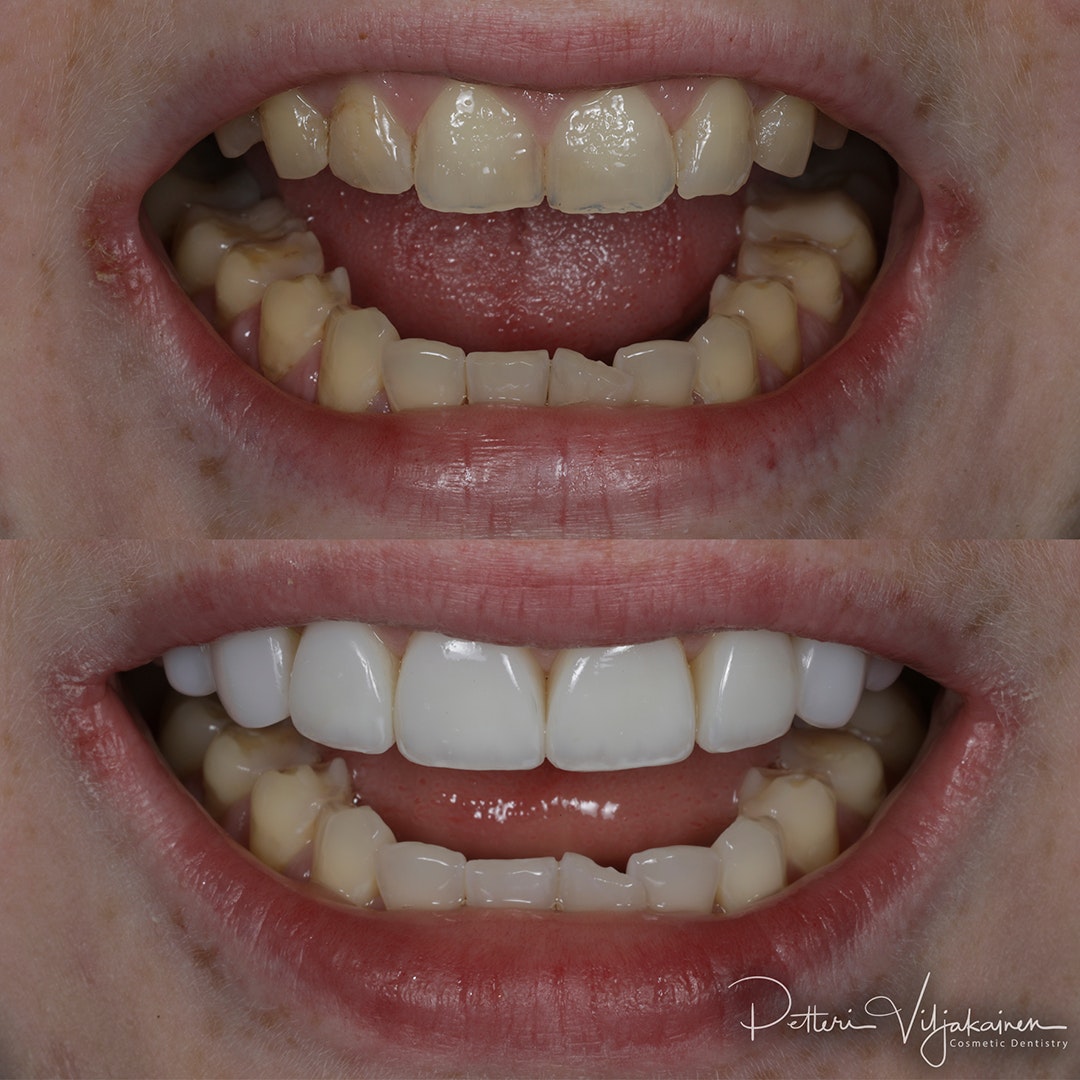 Invisalign oikomishoito ennen.