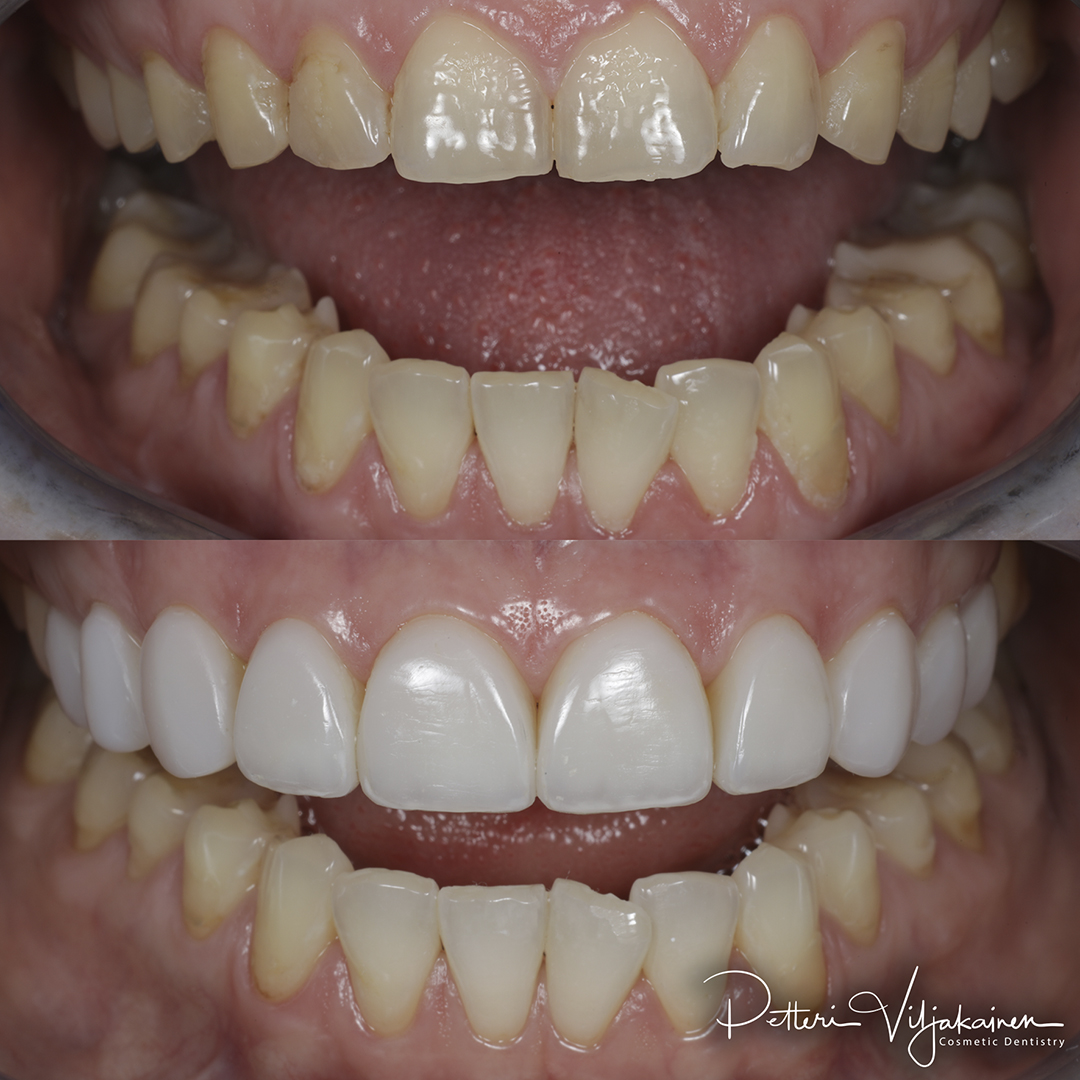 Reunimmaisessa yläetuhampaassa Invisalign oikomisen jälkeen yksittäinen keraaminen kuori eli hammaslaminaatti.