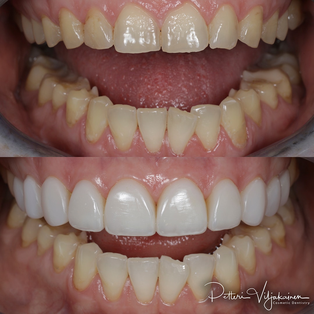 Reunimmaisessa yläetuhampaassa Invisalign oikomisen jälkeen yksittäinen keraaminen kuori eli hammaslaminaatti.