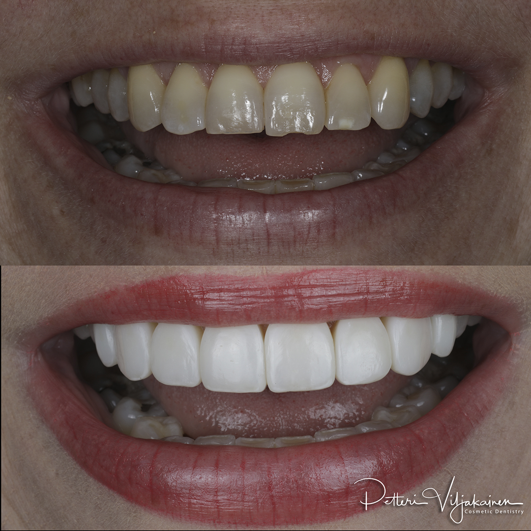 Esteettinen hammashoito Helsinki hampaat ennen
