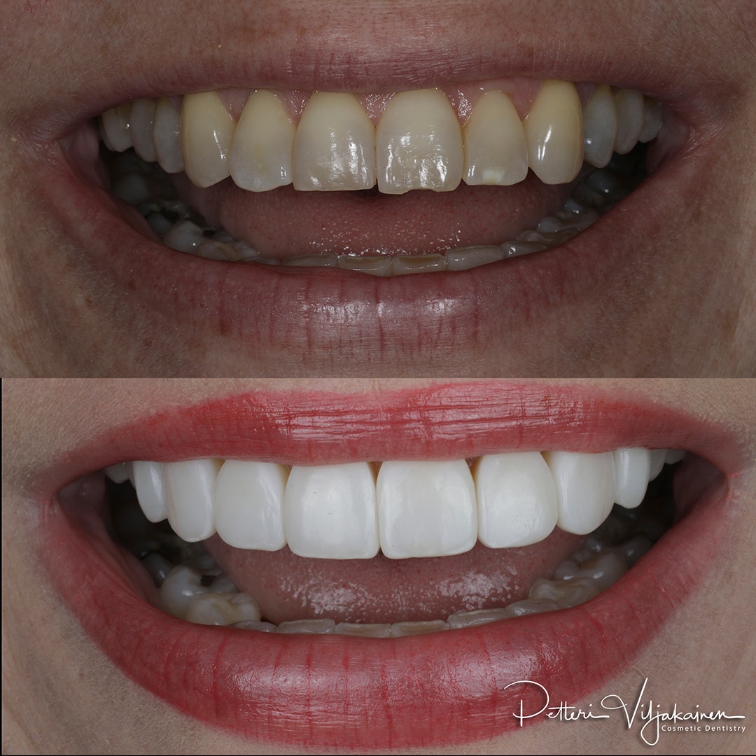 Esteettinen hammashoito Helsinki hampaat ennen