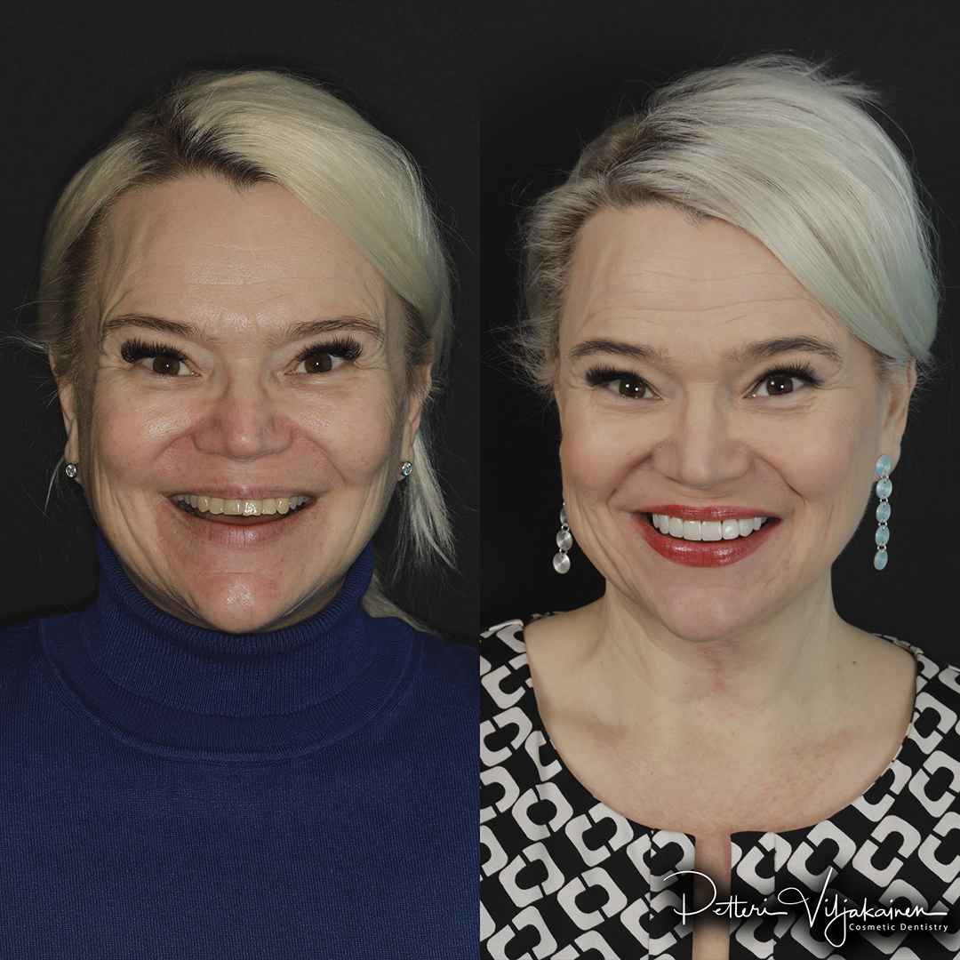 Esteettinen hammashoito Helsinki hampaat ennen