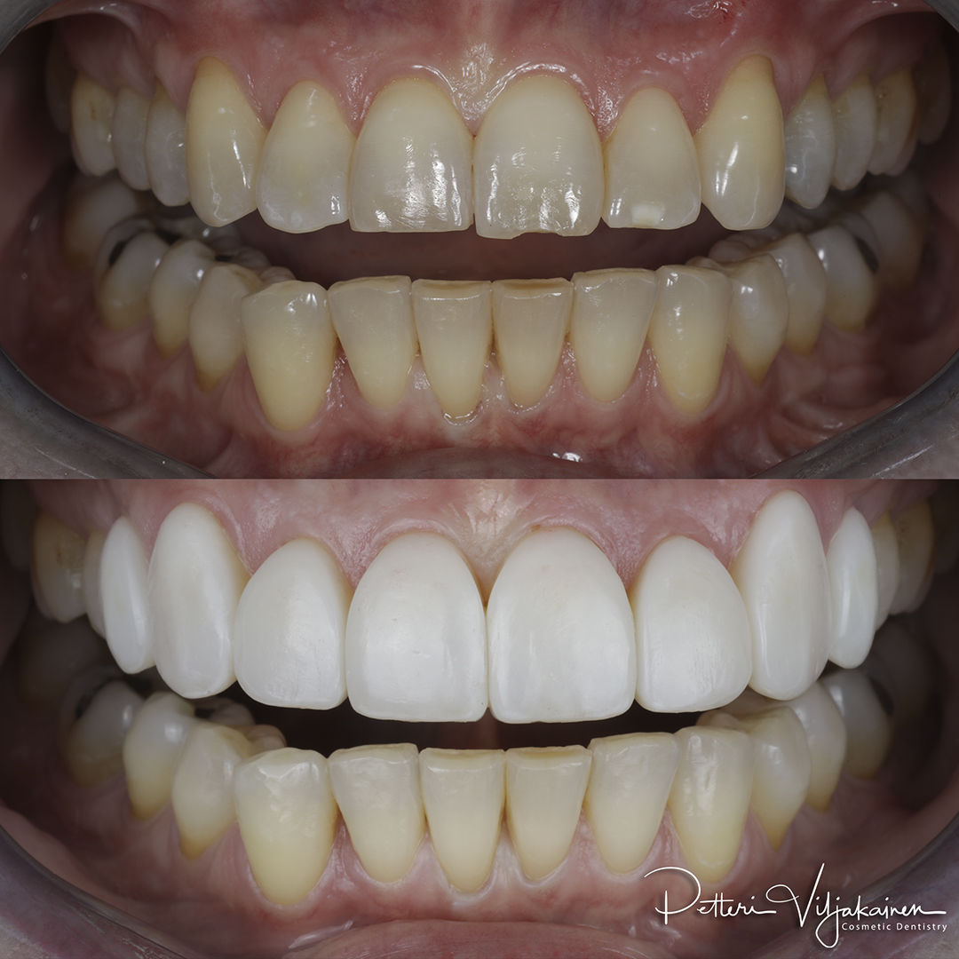 Esteettinen hammashoito Helsinki hampaat ennen