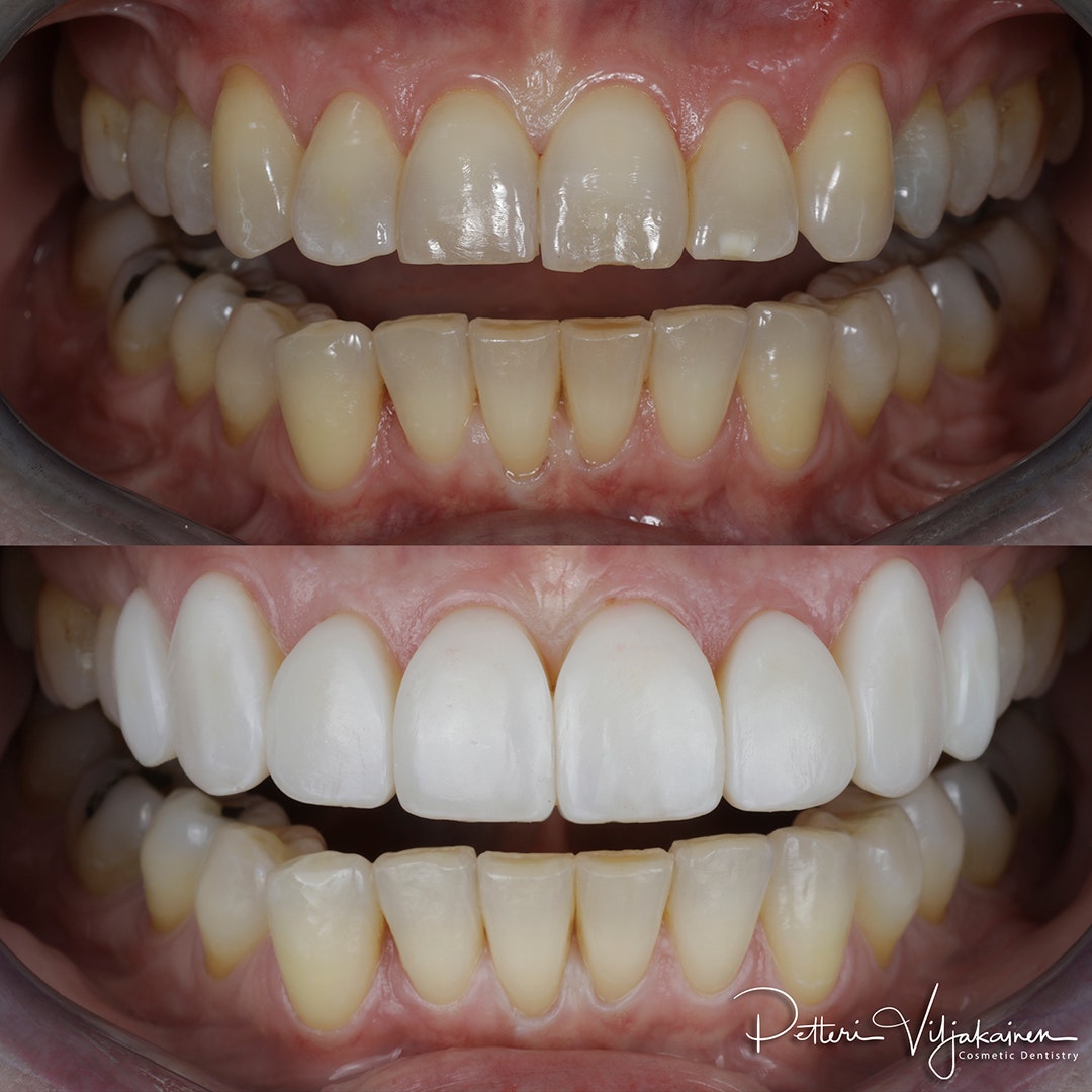 Esteettinen hammashoito Helsinki hampaat ennen