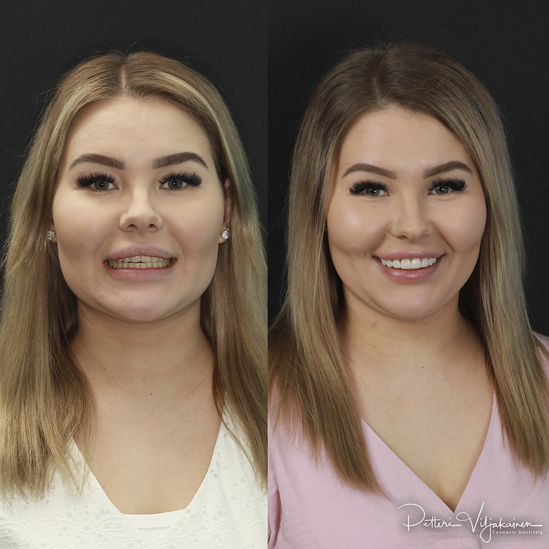 Invisalign oikomishoito ennen.