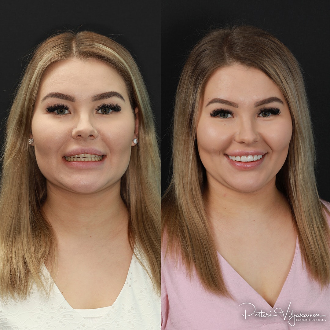 Invisalign oikomishoito ennen.