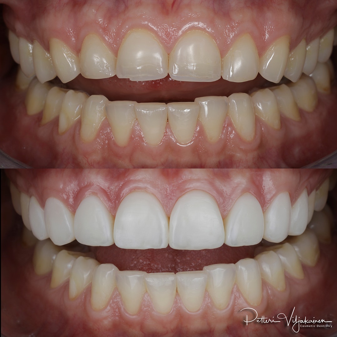 Invisalign oikomishoito ennen.