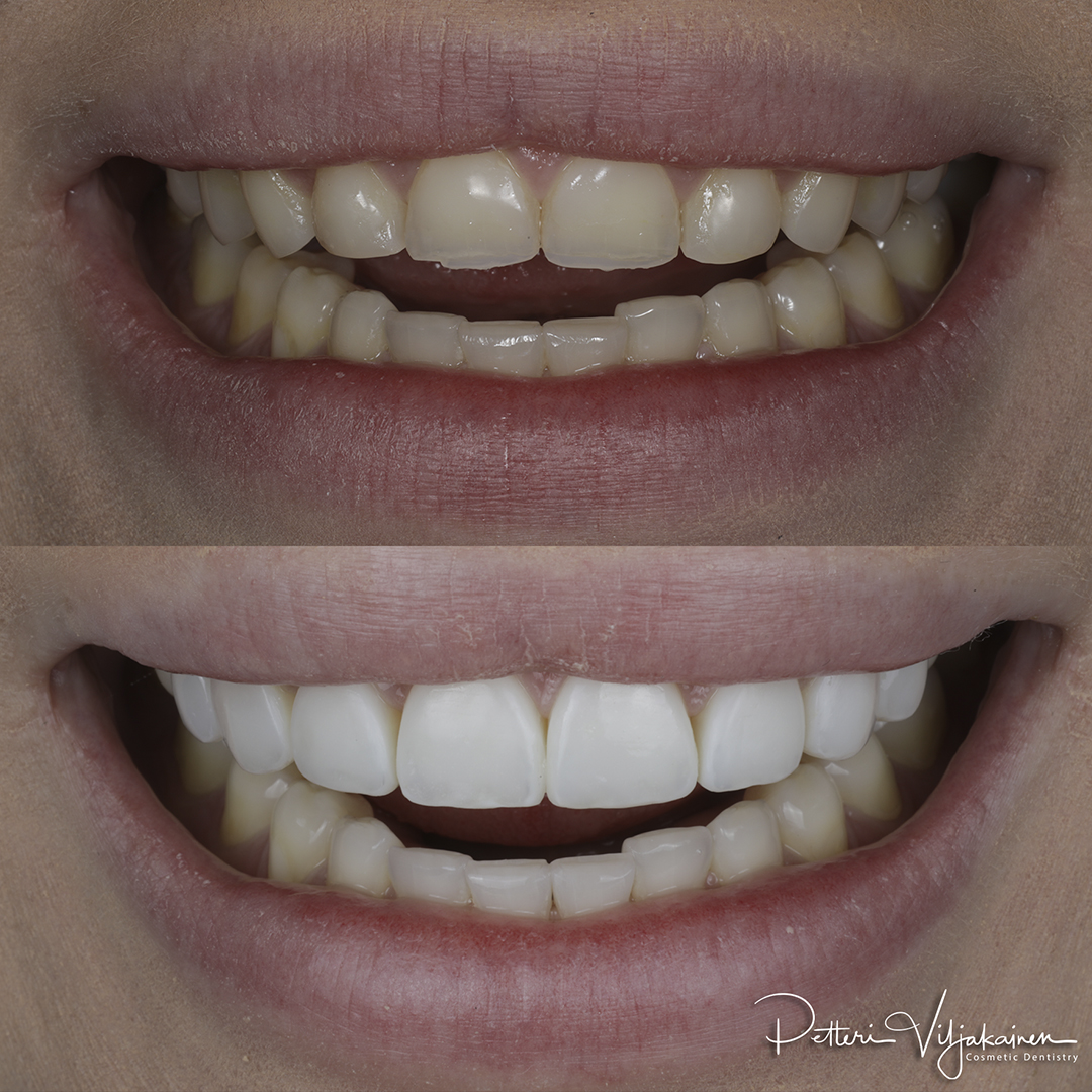 Invisalign oikomishoito jälkeen. Kahdeksaan yläetuhampaaseen tehtiin keraamiset kuoret eli hammaslaminaatit.