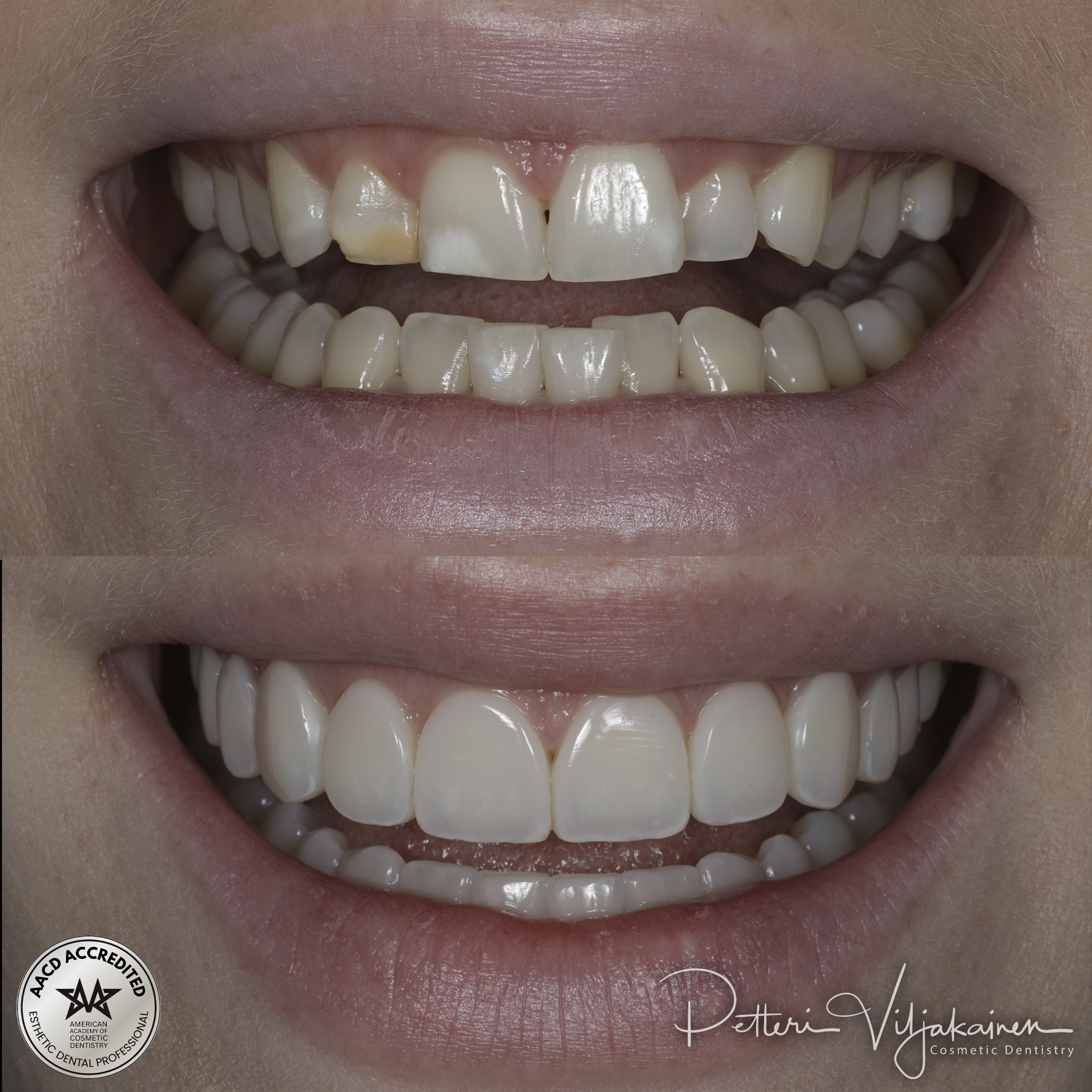 Invisalign oikomishoito ennen.