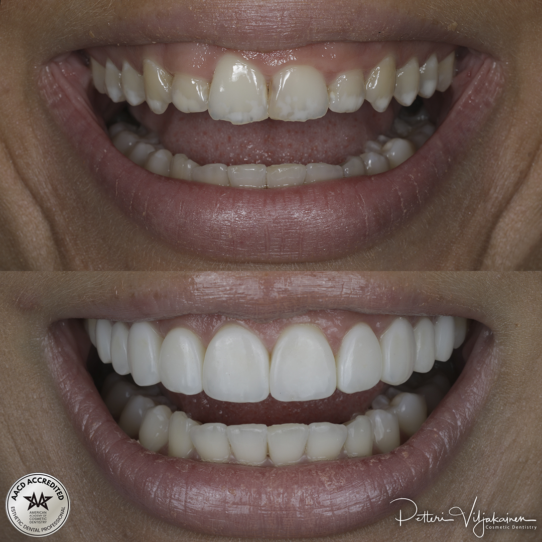 Invisalign oikomishoito ennen.