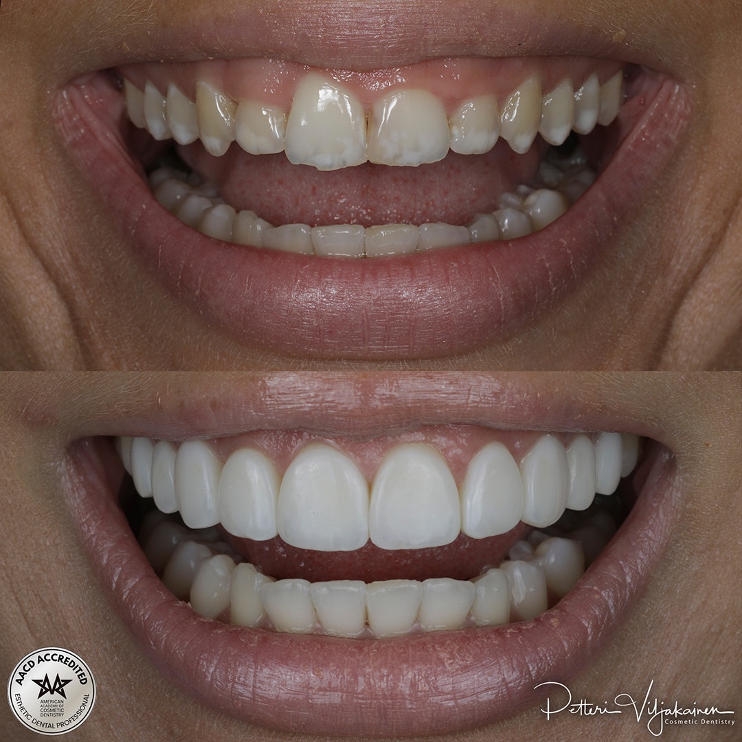 Esteettinen hammashoito Helsinki hampaat ennen
