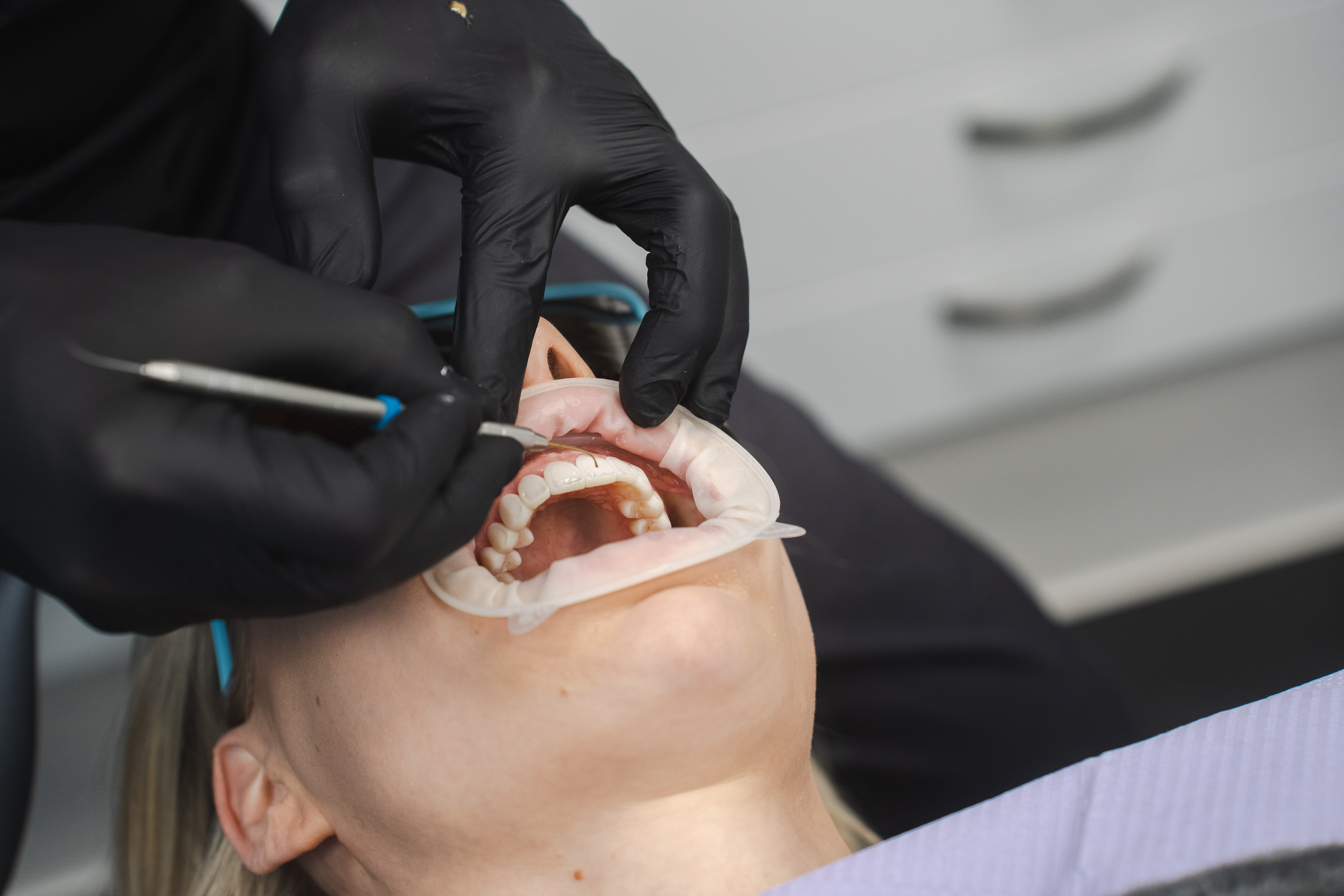 Invisalign oikomishoito ennen