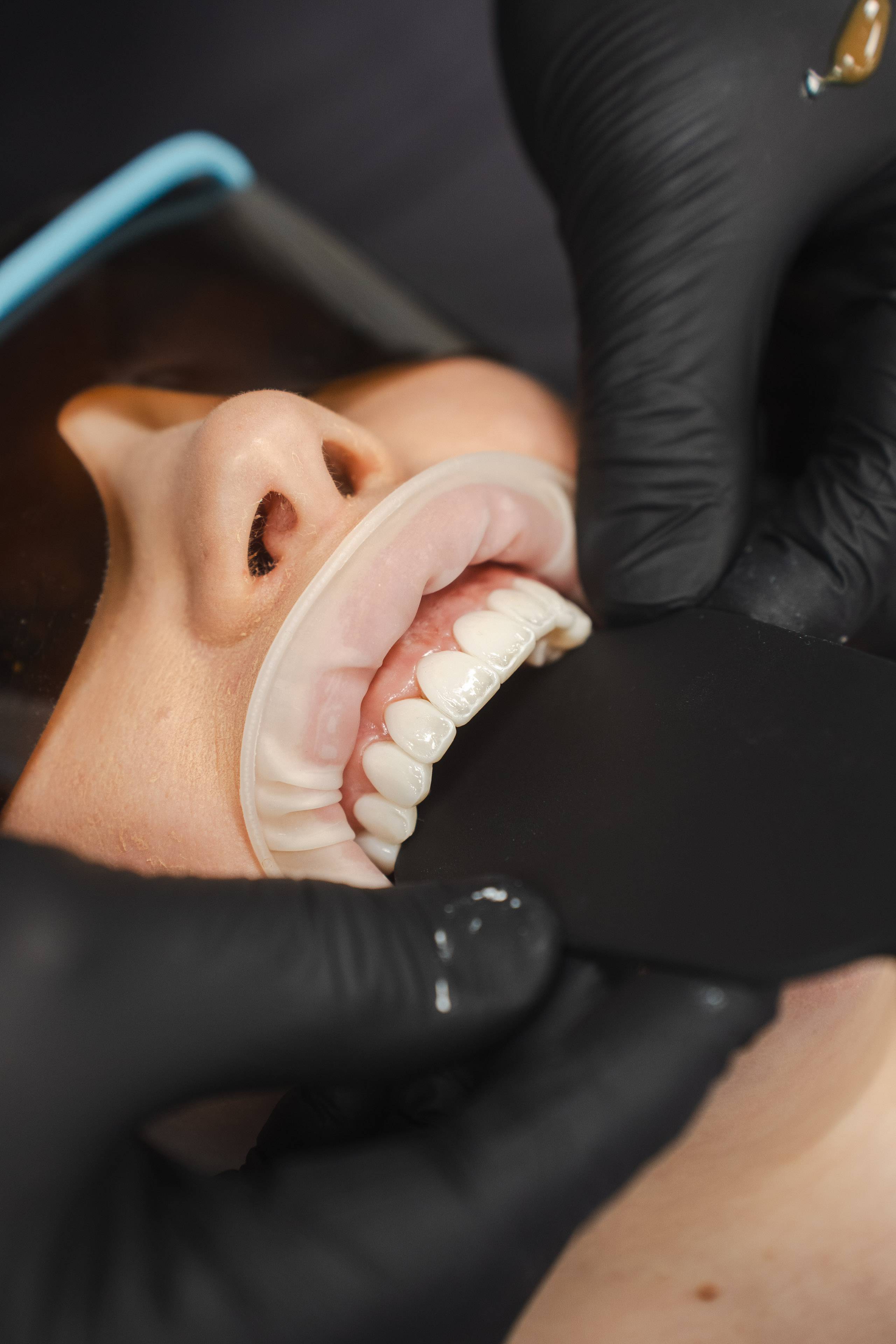 Invisalign oikomishoito ennen