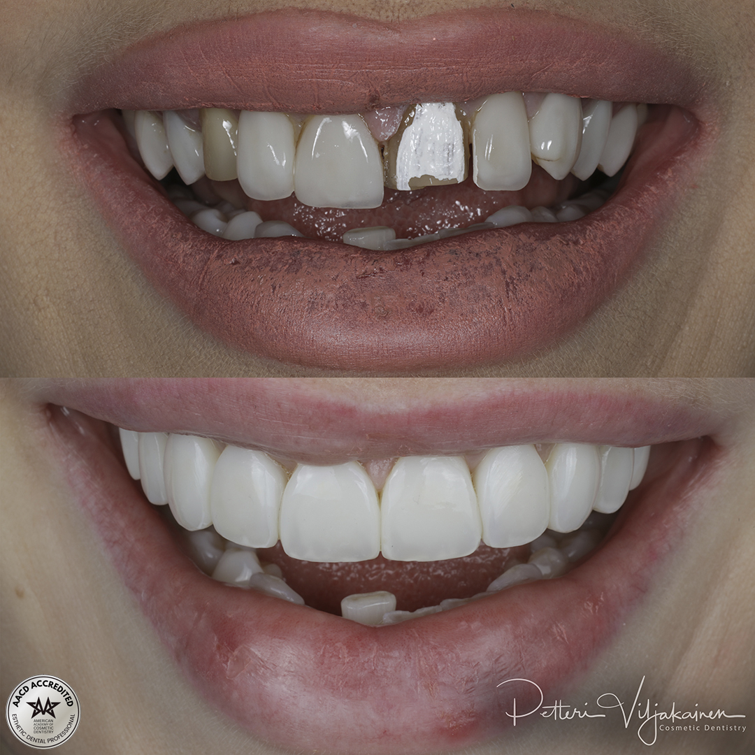 Invisalign oikomishoito ennen.