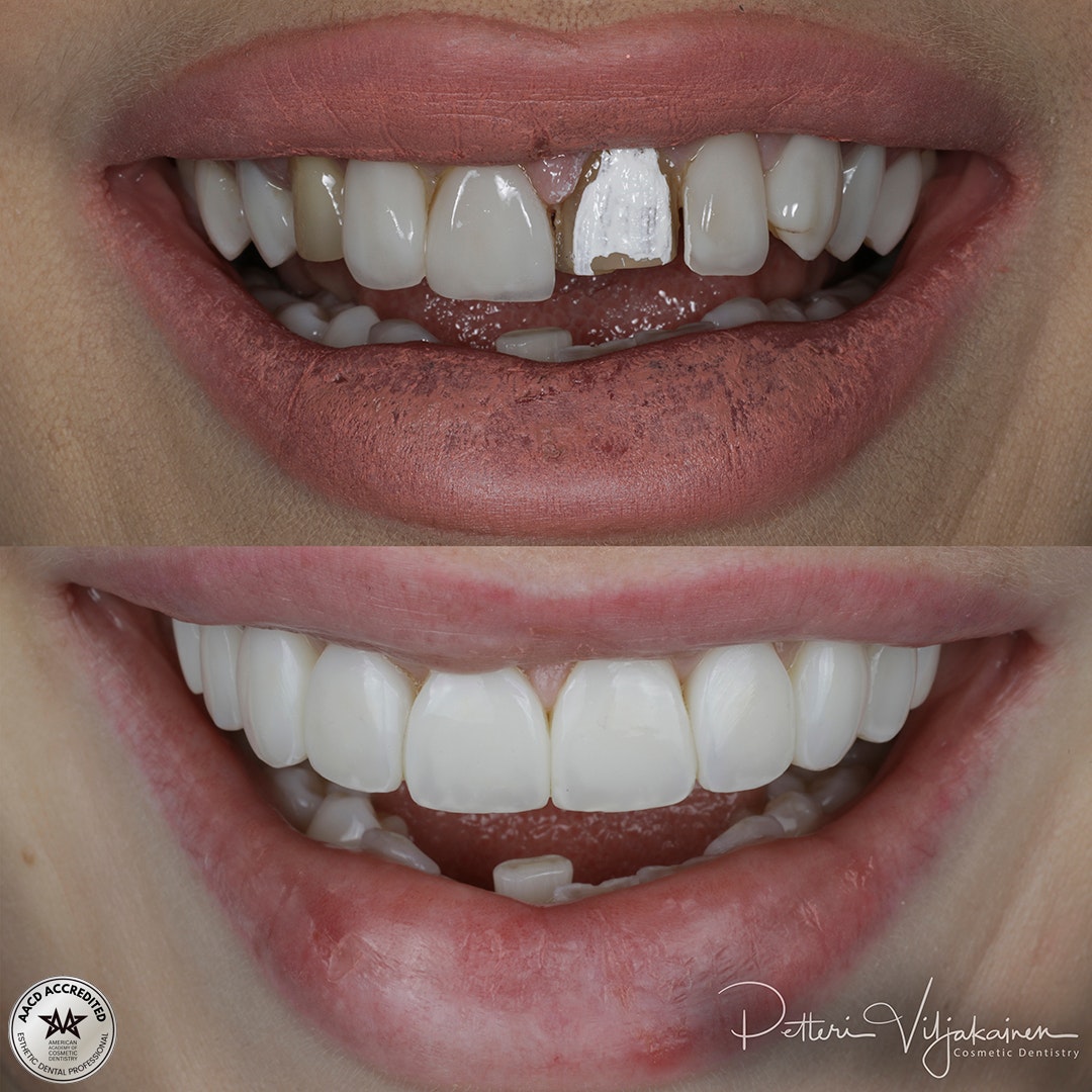 Invisalign oikomishoito ennen.