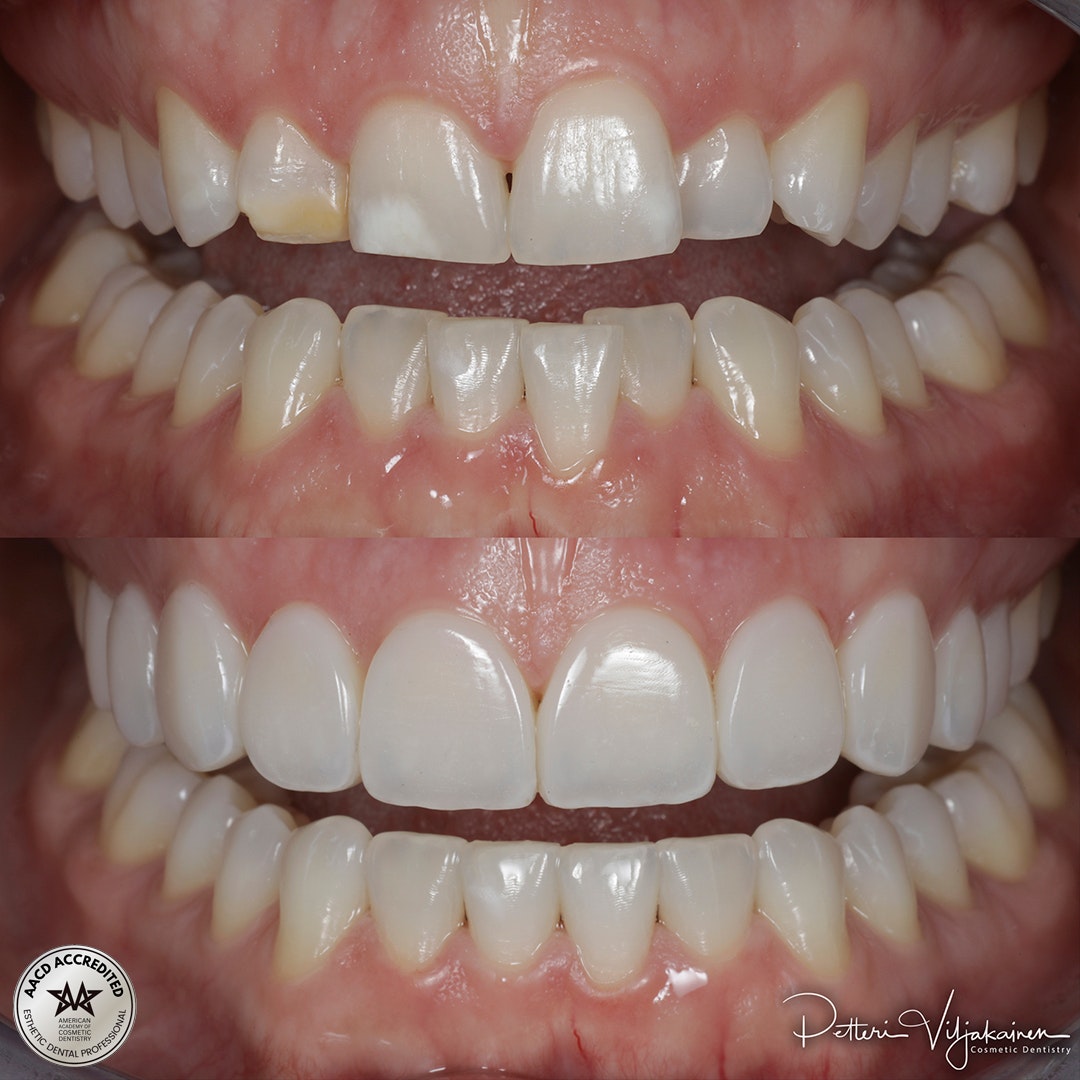 Reunimmaisessa yläetuhampaassa Invisalign oikomisen jälkeen yksittäinen keraaminen kuori eli hammaslaminaatti.