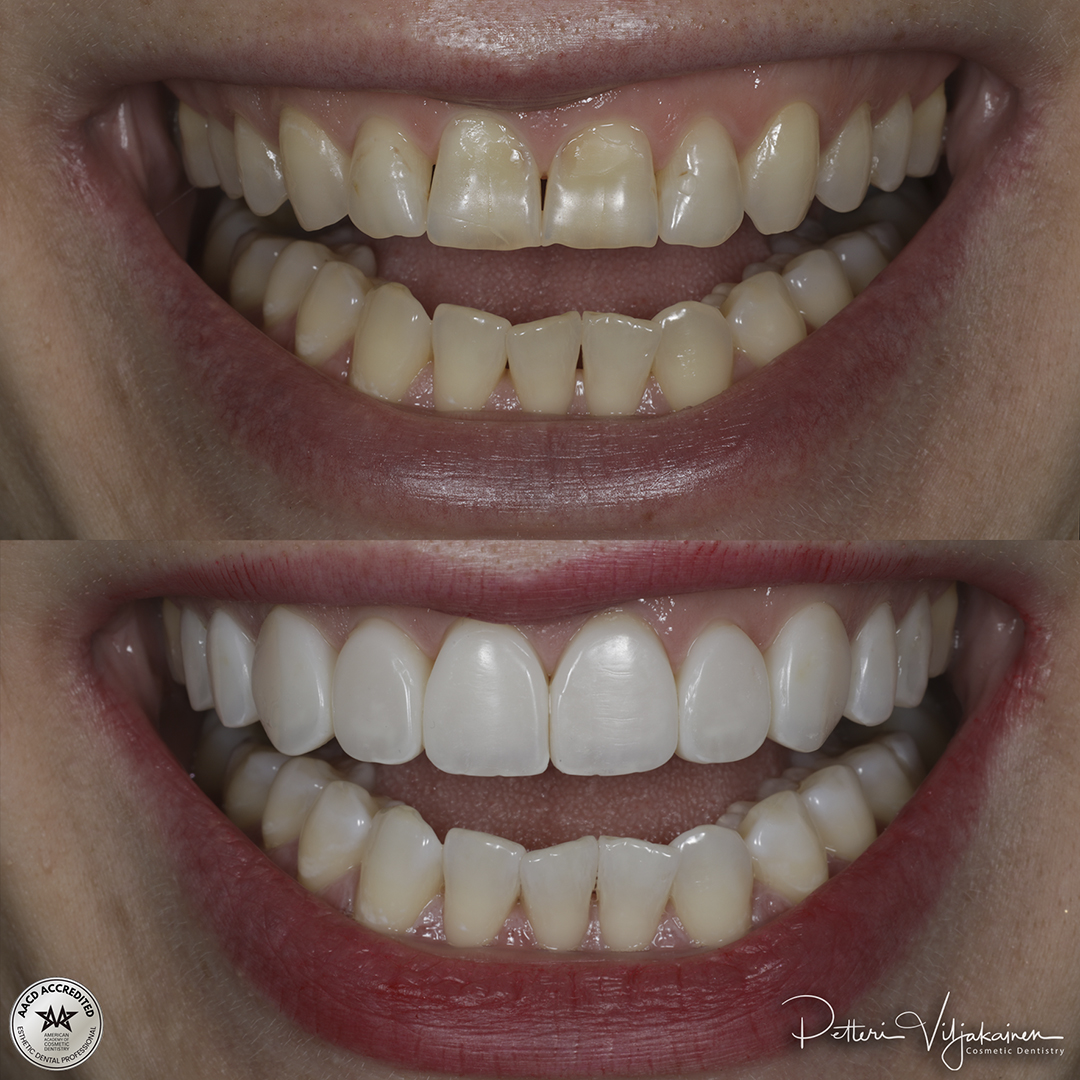 Invisalign oikomishoito ennen.