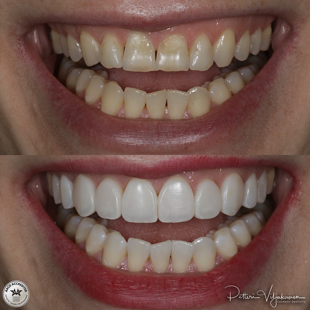 Invisalign oikomishoito ennen.