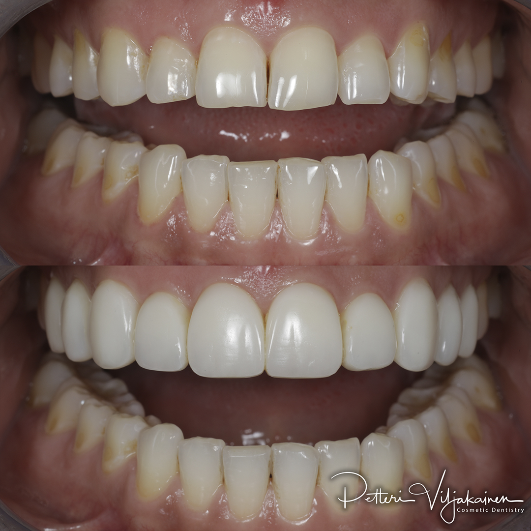 Invisalign oikomishoito jälkeen. Kahdeksaan yläetuhampaaseen tehtiin keraamiset kuoret eli hammaslaminaatit.