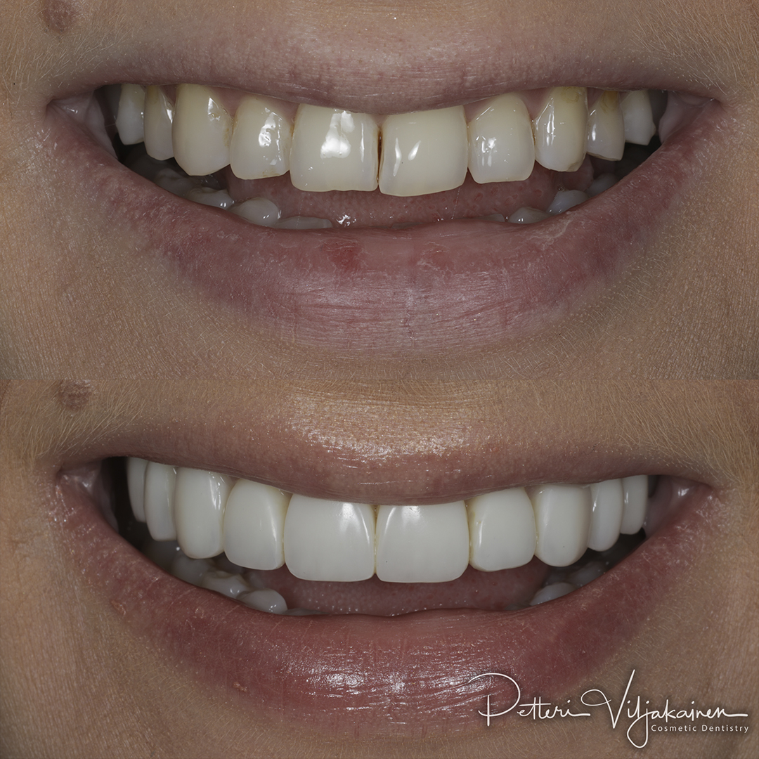 Invisalign oikomishoito jälkeen. Kahdeksaan yläetuhampaaseen tehtiin keraamiset kuoret eli hammaslaminaatit.