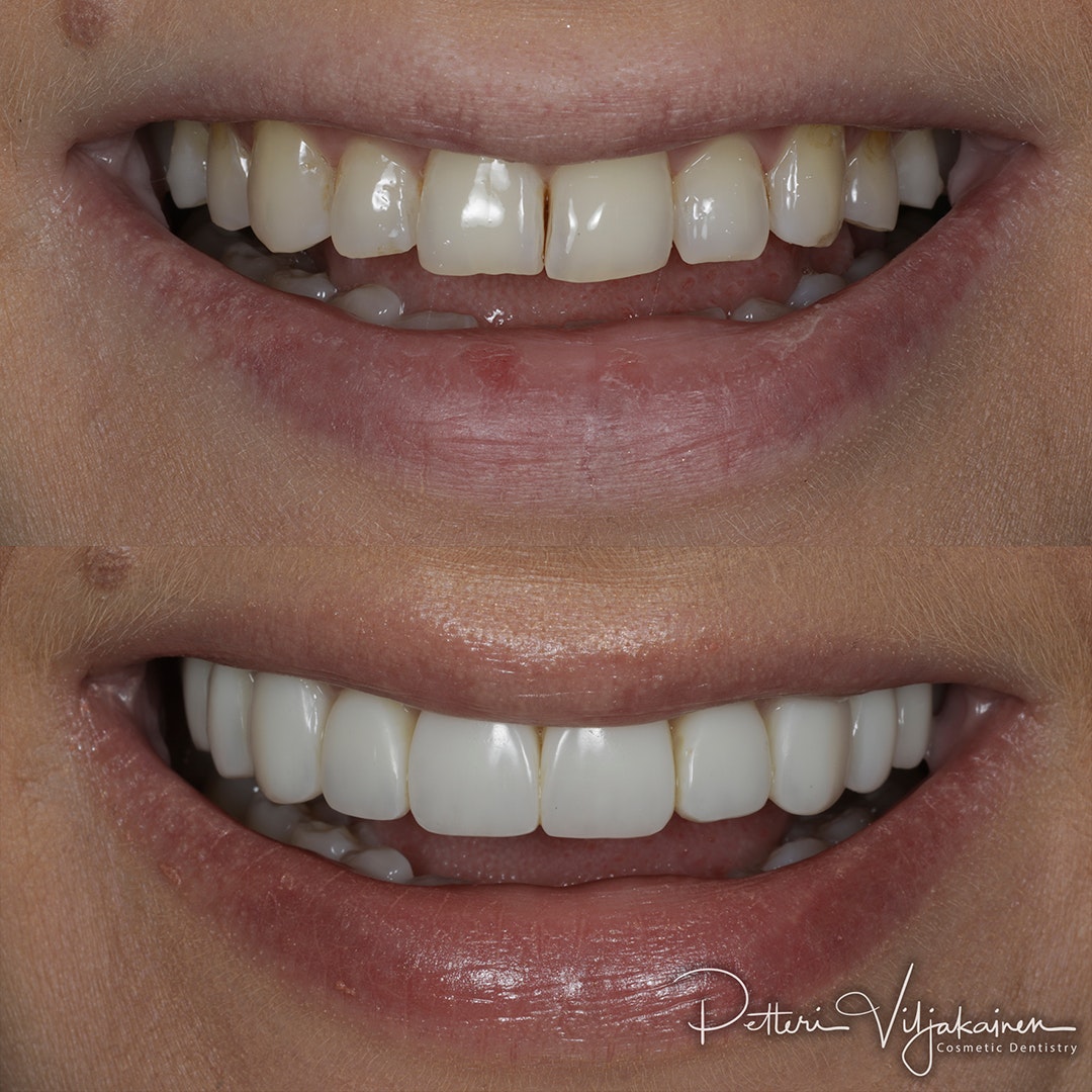 Invisalign oikomishoito jälkeen. Kahdeksaan yläetuhampaaseen tehtiin keraamiset kuoret eli hammaslaminaatit.