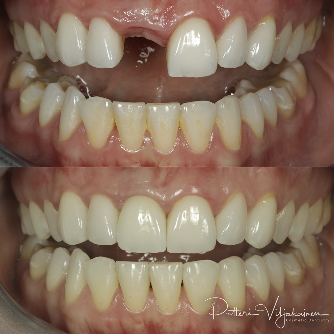 Esteettinen hammashoito ennen