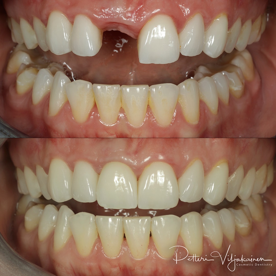 Esteettinen hammashoito ennen