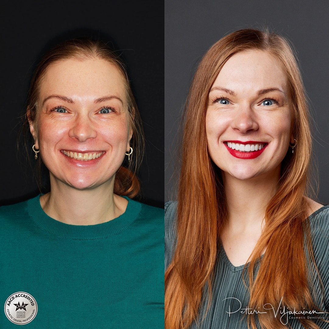 Reunimmaisessa yläetuhampaassa Invisalign oikomisen jälkeen yksittäinen keraaminen kuori eli hammaslaminaatti.