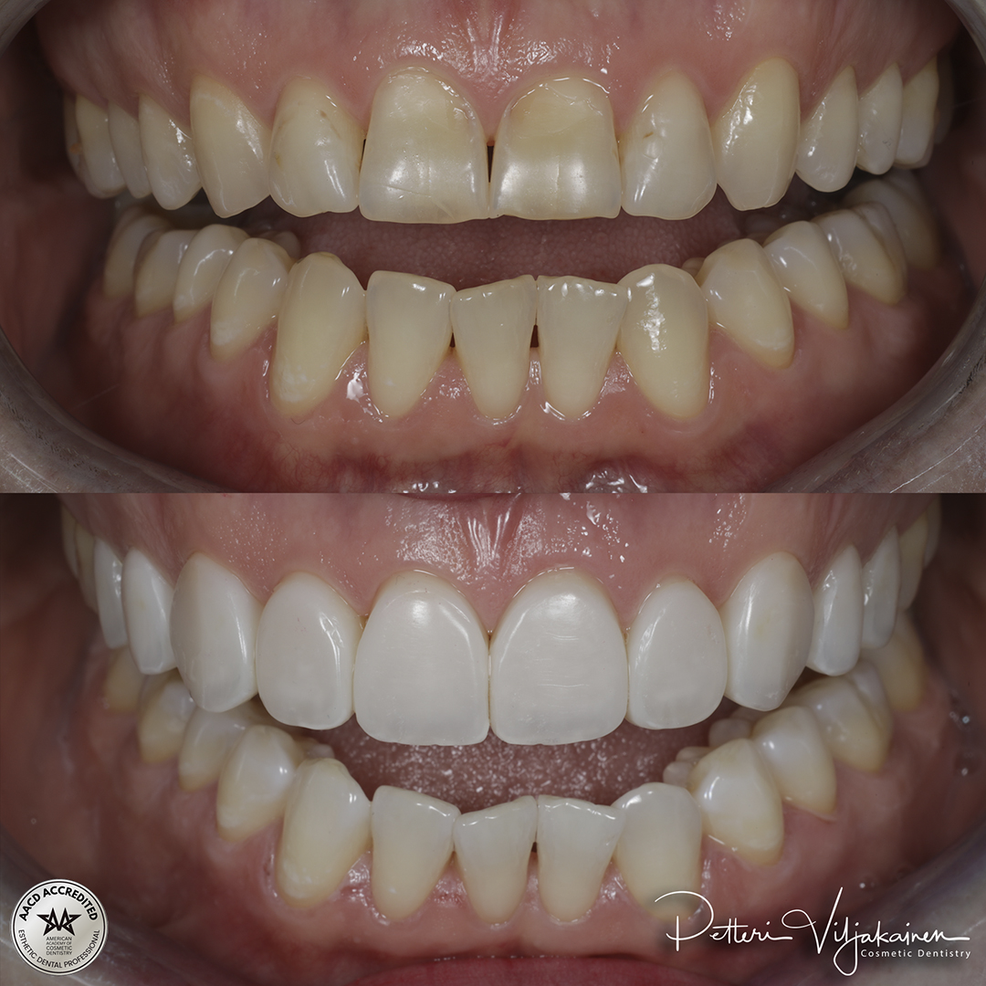 Reunimmaisessa yläetuhampaassa Invisalign oikomisen jälkeen yksittäinen keraaminen kuori eli hammaslaminaatti.