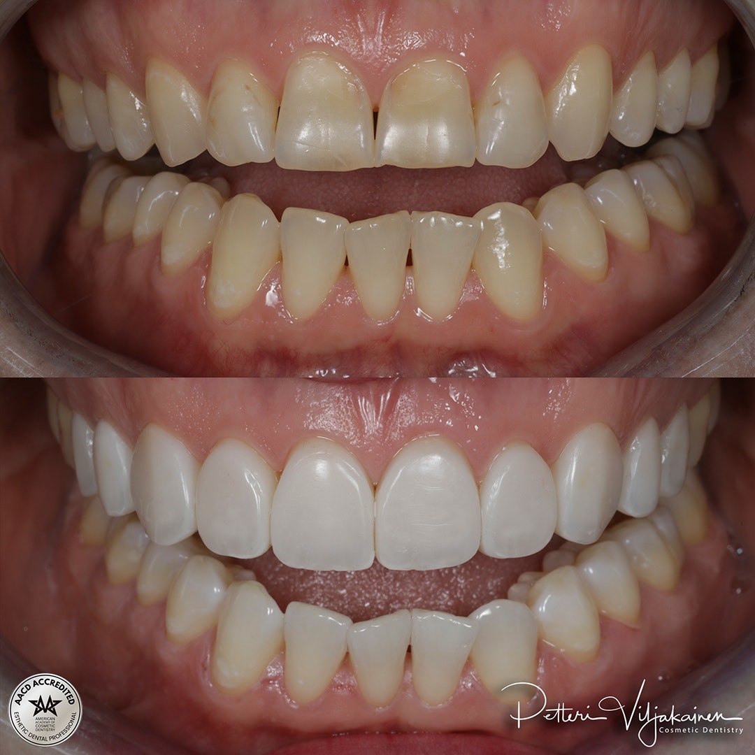 Reunimmaisessa yläetuhampaassa Invisalign oikomisen jälkeen yksittäinen keraaminen kuori eli hammaslaminaatti.