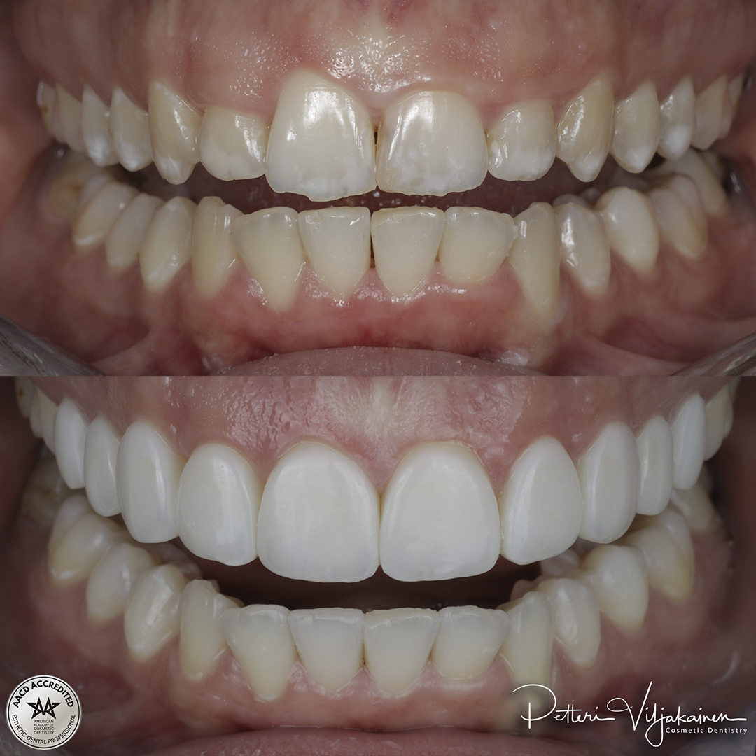 Esteettinen hammashoito Helsinki hampaat jälkeen