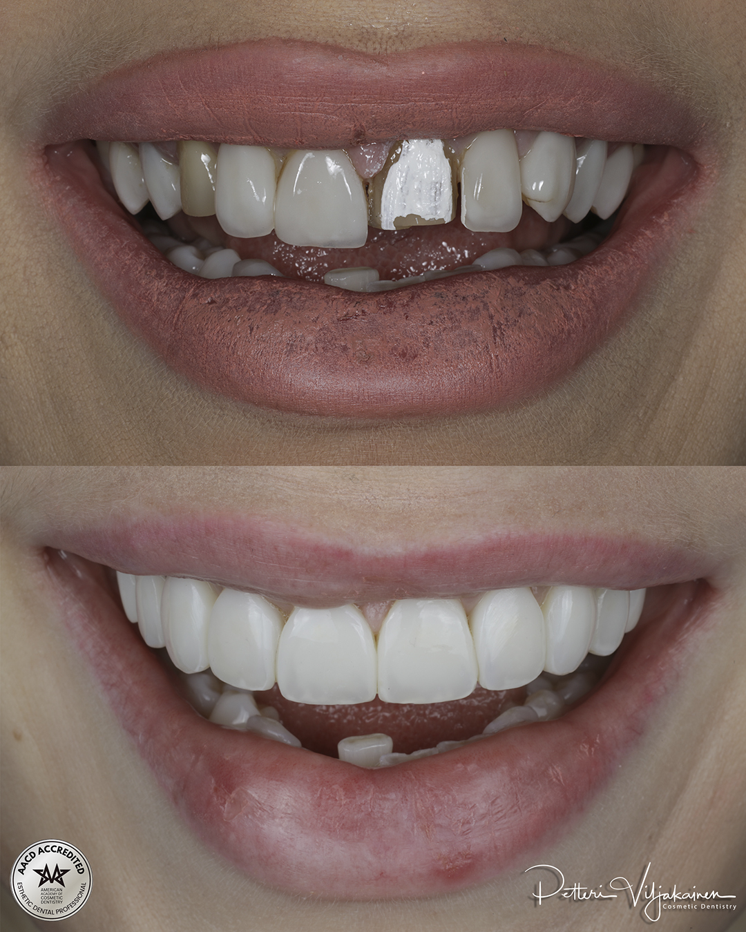 Reunimmaisessa yläetuhampaassa Invisalign oikomisen jälkeen yksittäinen keraaminen kuori eli hammaslaminaatti.