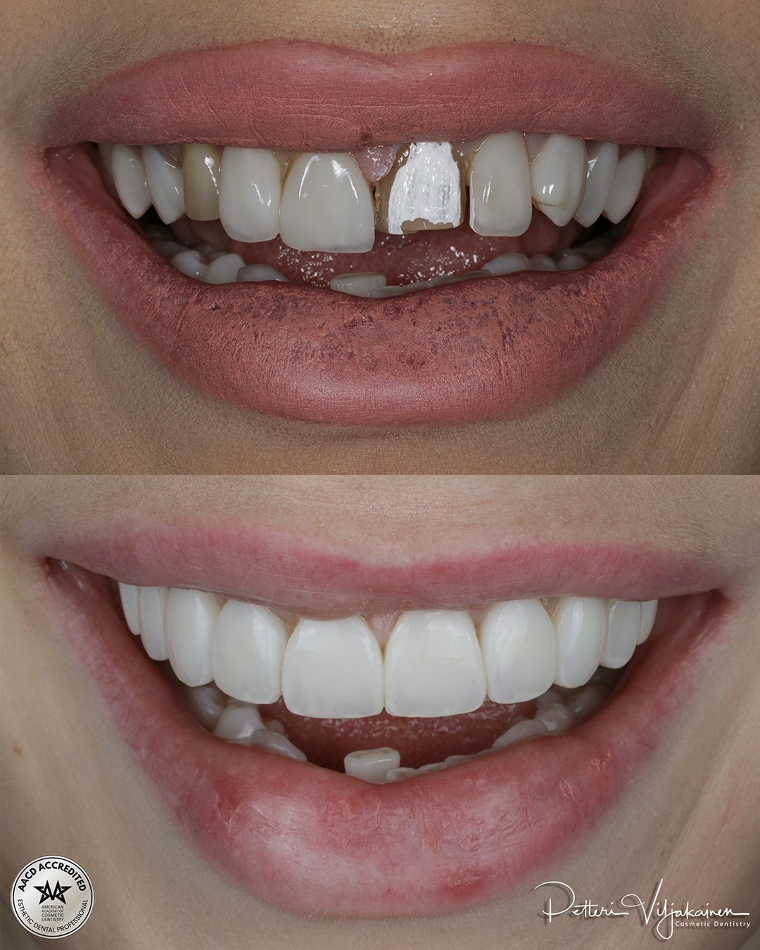 Reunimmaisessa yläetuhampaassa Invisalign oikomisen jälkeen yksittäinen keraaminen kuori eli hammaslaminaatti.