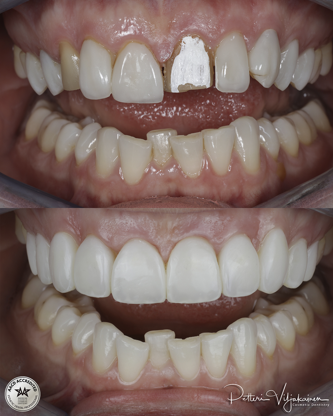 Reunimmaisessa yläetuhampaassa Invisalign oikomisen jälkeen yksittäinen keraaminen kuori eli hammaslaminaatti.