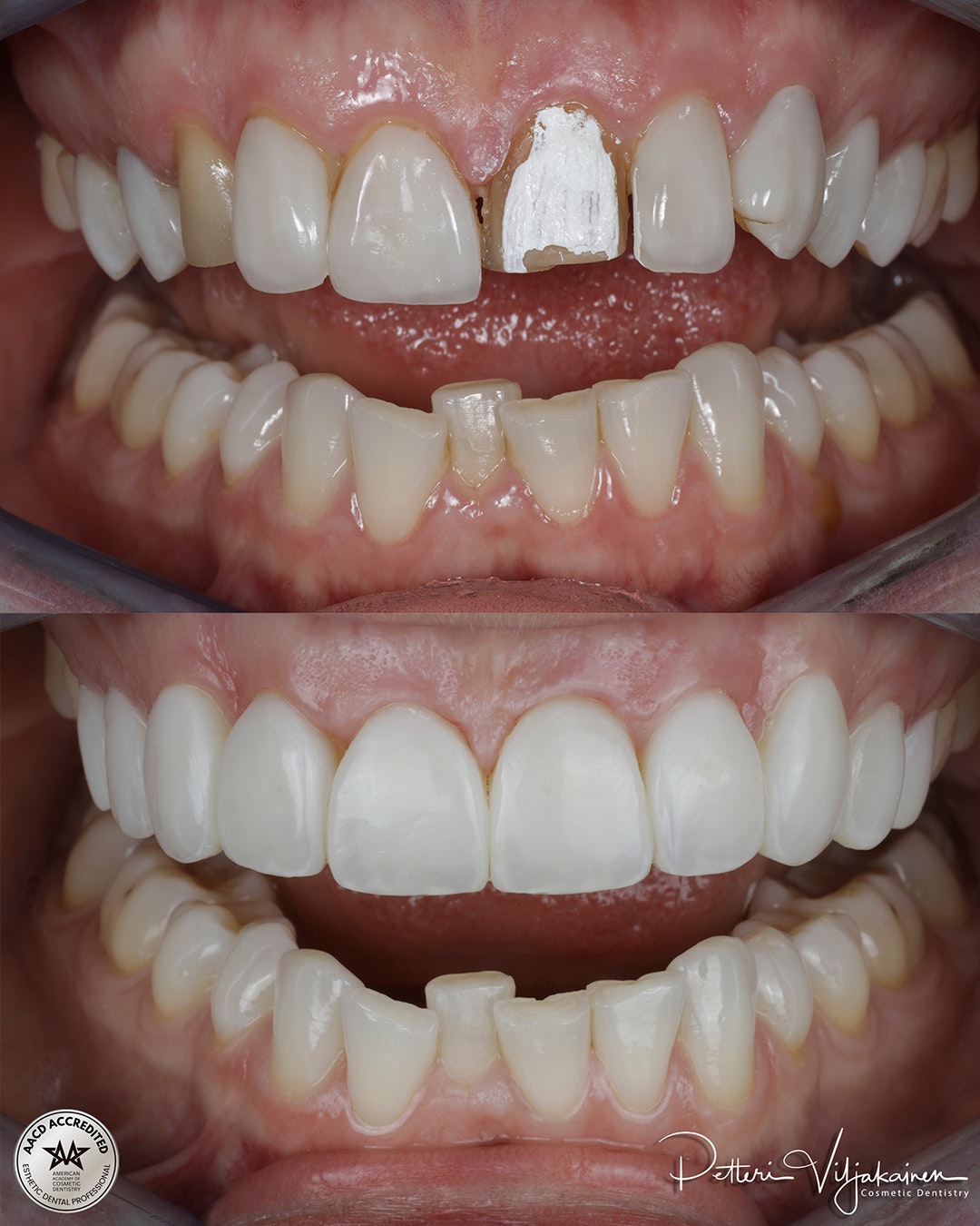 Reunimmaisessa yläetuhampaassa Invisalign oikomisen jälkeen yksittäinen keraaminen kuori eli hammaslaminaatti.