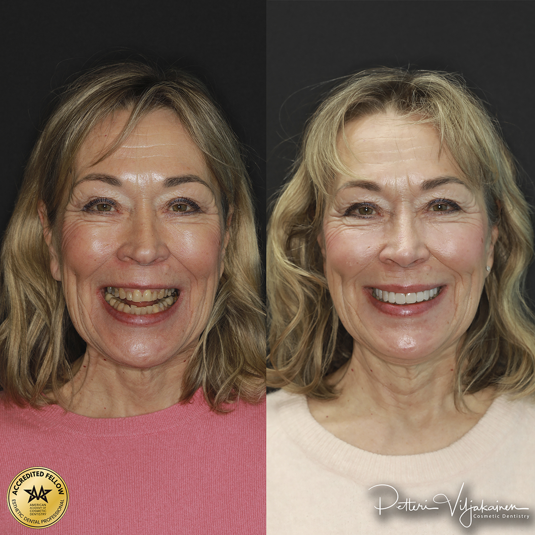 Invisalign oikomishoito ennen.