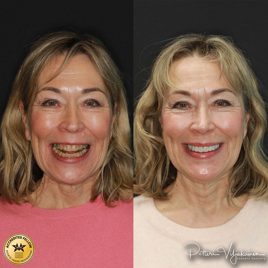 Invisalign oikomishoito ennen.