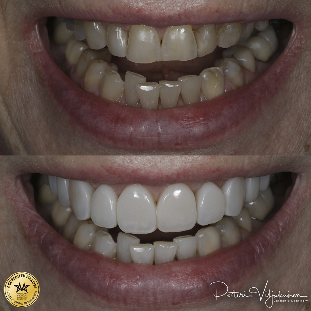 Reunimmaisessa yläetuhampaassa Invisalign oikomisen jälkeen yksittäinen keraaminen kuori eli hammaslaminaatti.