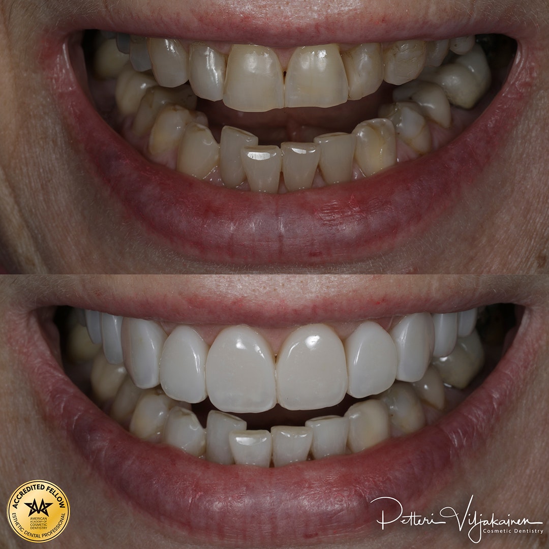Reunimmaisessa yläetuhampaassa Invisalign oikomisen jälkeen yksittäinen keraaminen kuori eli hammaslaminaatti.