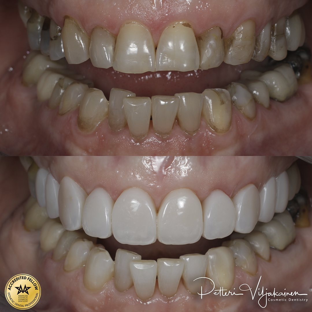 Invisalign oikomishoito ennen.