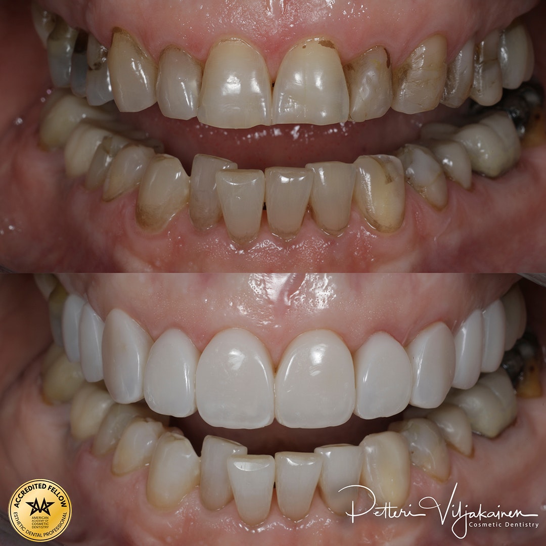 Invisalign oikomishoito ennen.