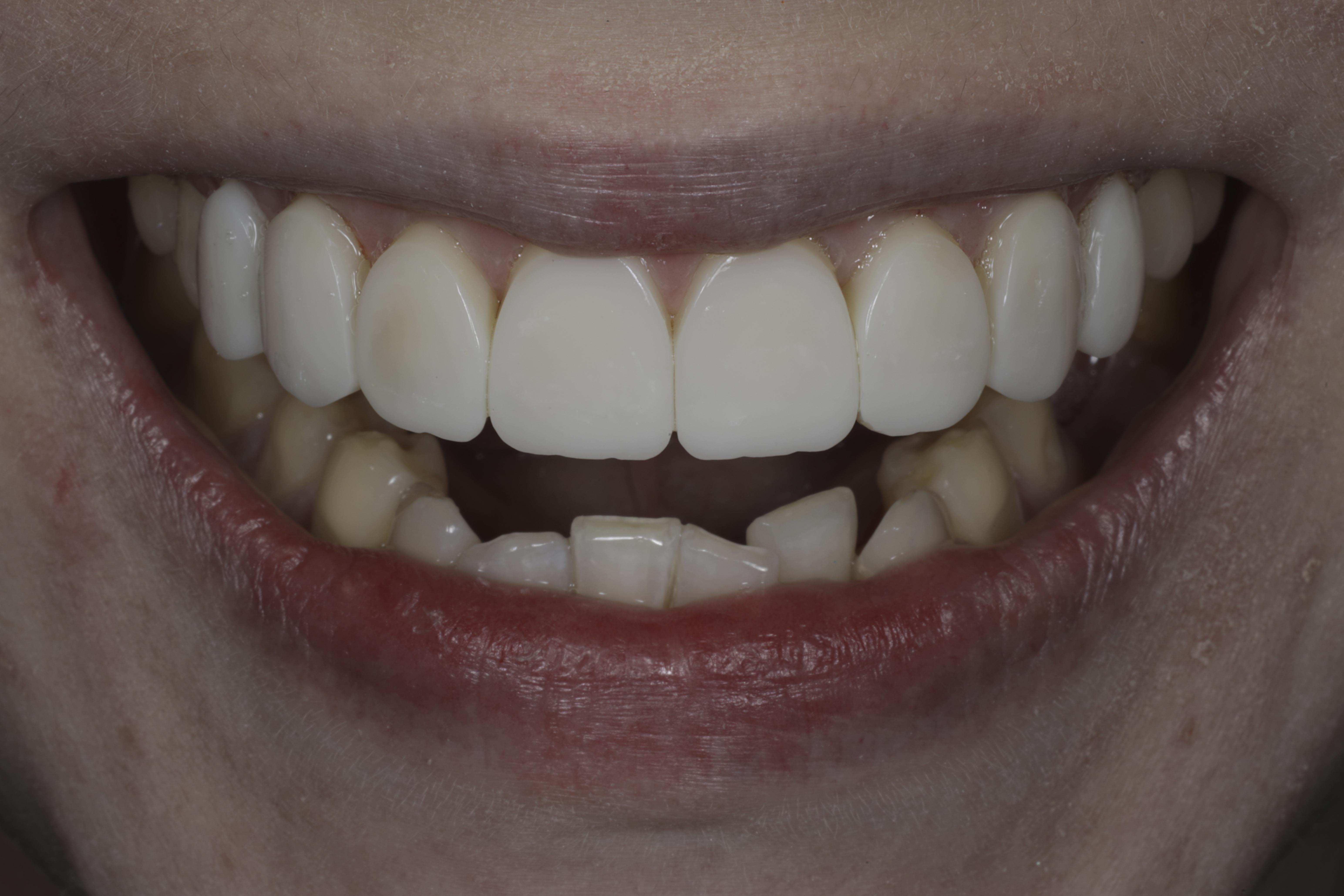 Reunimmaisessa yläetuhampaassa Invisalign oikomisen jälkeen yksittäinen keraaminen kuori eli hammaslaminaatti.