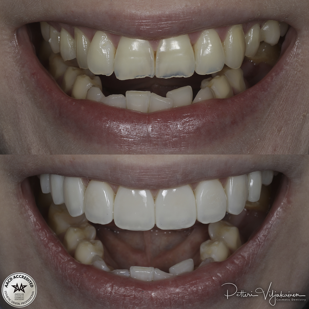 Invisalign oikomishoito ennen.