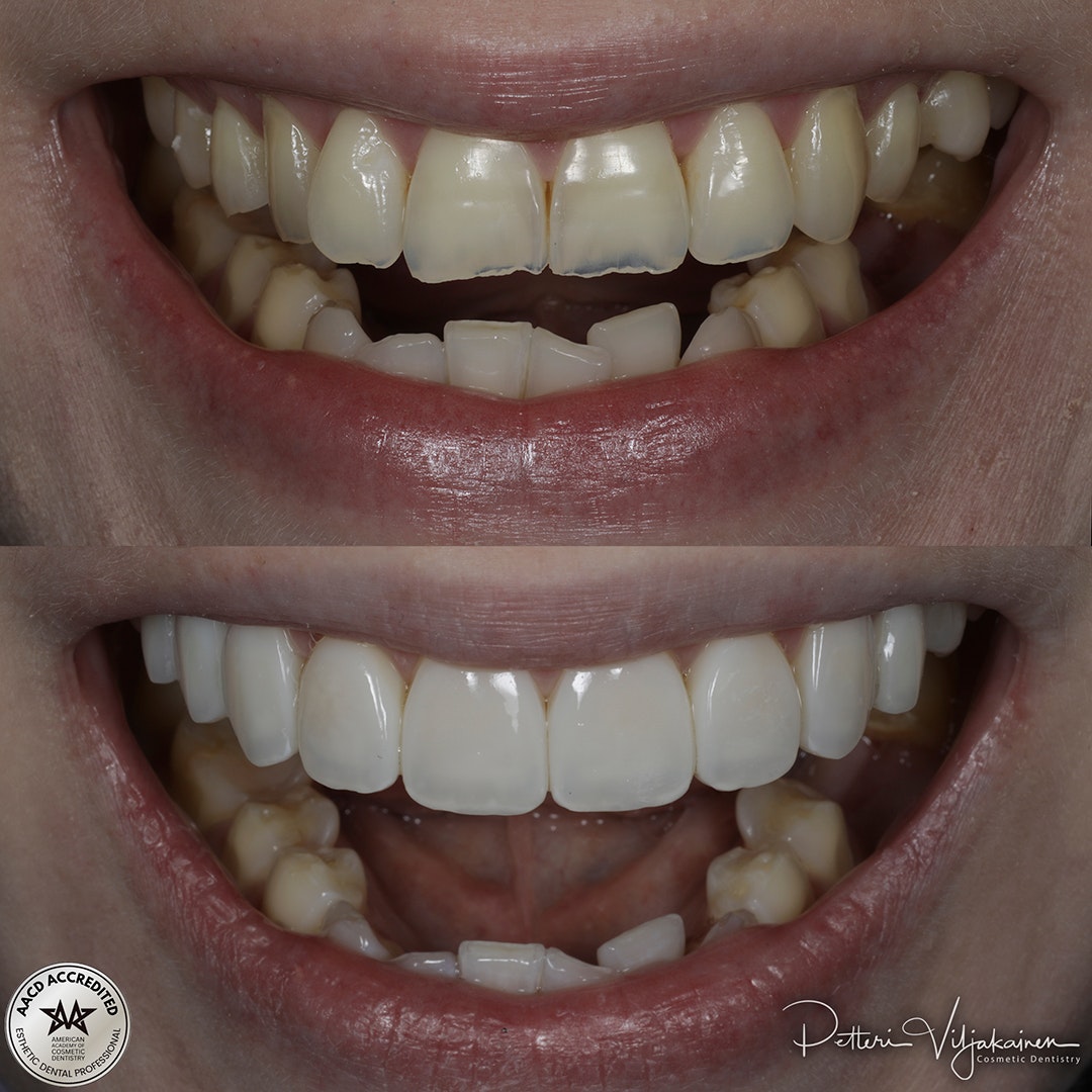 Invisalign oikomishoito ennen.