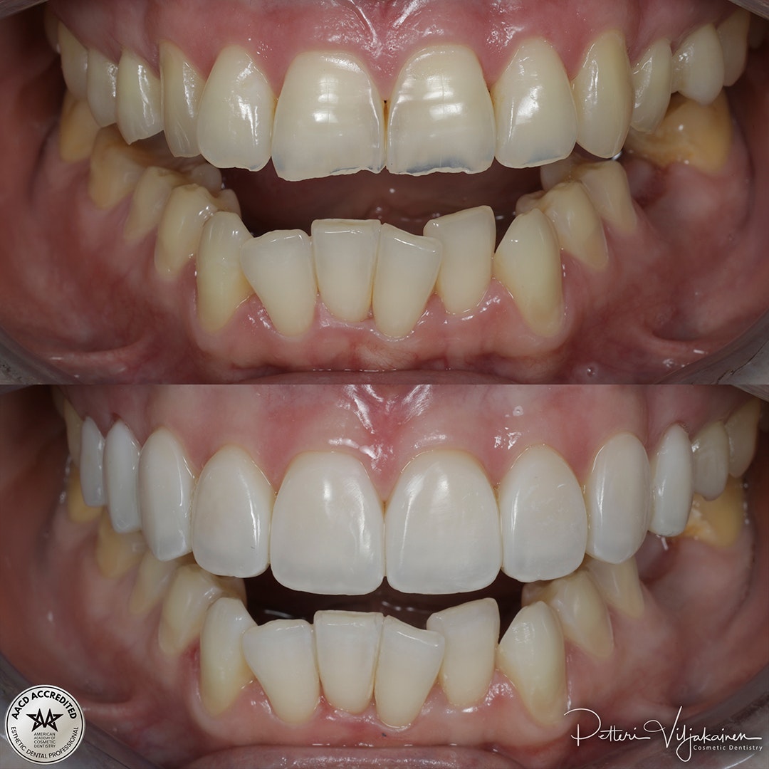 Reunimmaisessa yläetuhampaassa Invisalign oikomisen jälkeen yksittäinen keraaminen kuori eli hammaslaminaatti.